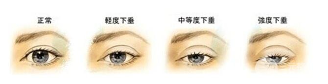 关于眼皮松弛的手术,再也不用担心眼部衰老问题了