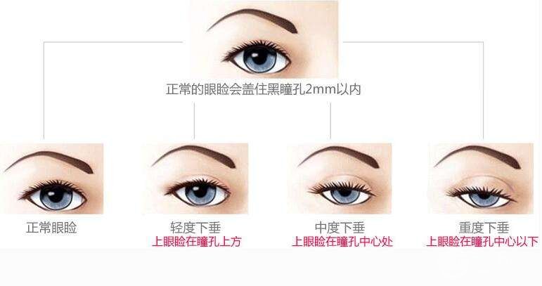 关于眼皮松弛的手术,再也不用担心眼部衰老问题了