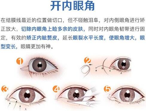 韩式开眼角整形手术容易留疤的原因,在这里