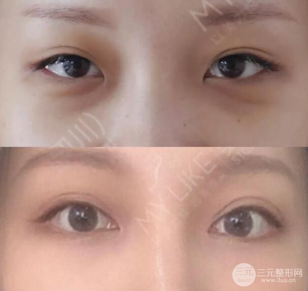 韩式开眼角整形手术容易留疤的原因,在这里