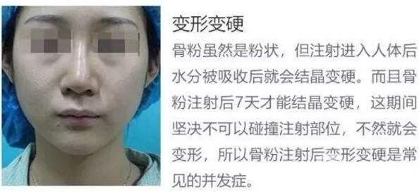 骨粉隆鼻的危害,都2020年了你还不知道吗?