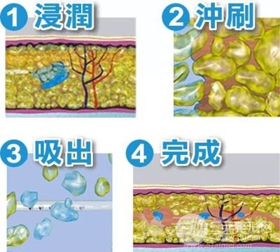 水动力吸脂