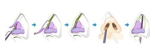 非截骨矫正方式