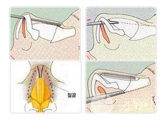 Joseph氏手术方式