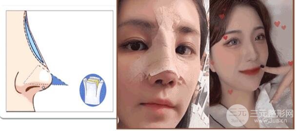 矫正手术的护理