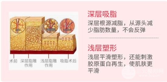 面部吸脂瘦脸手术果