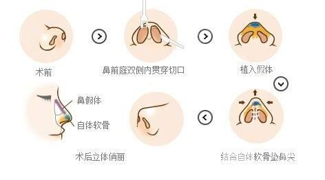 隆鼻手术的手术过程