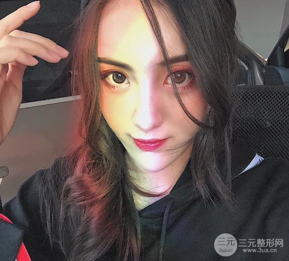 上海九院钱云良做的双眼皮案例,眼睛真的变大了不少