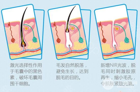 杭州邵逸夫美容激光科脱毛多少钱