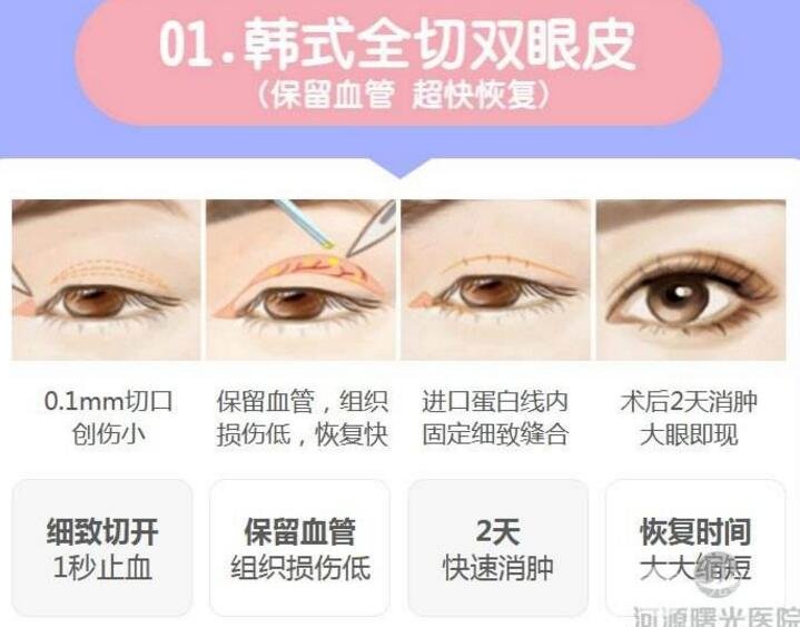 北京微创双眼皮多少钱