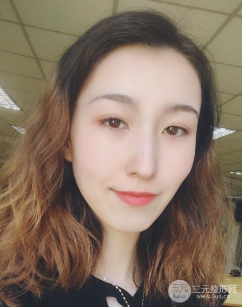 北京301郭伶俐怎么样鼻整形案例
