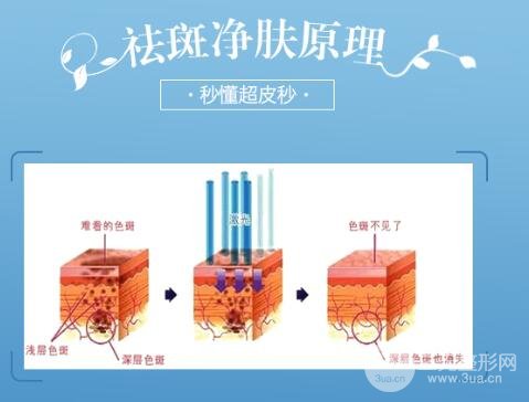 opt光子嫩肤祛斑美容仪
