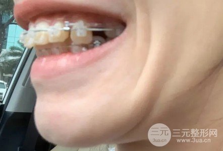 周口口腔医院牙齿矫正案例