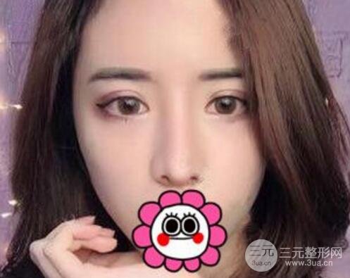 想知道膨体隆鼻手术多少钱?戳进来!