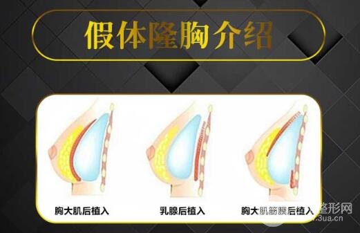 隆胸假体曼托怎么样？