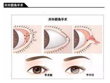 开外眼角手术原理