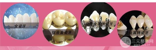 烤瓷牙价钱是多少?