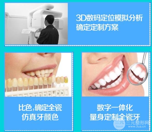 镍铬合金烤瓷牙