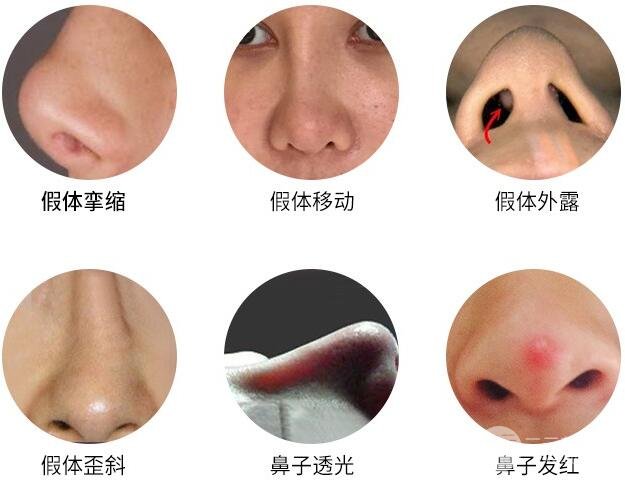 隆鼻失败别恐慌，修复手术成功的几率还是很大的！