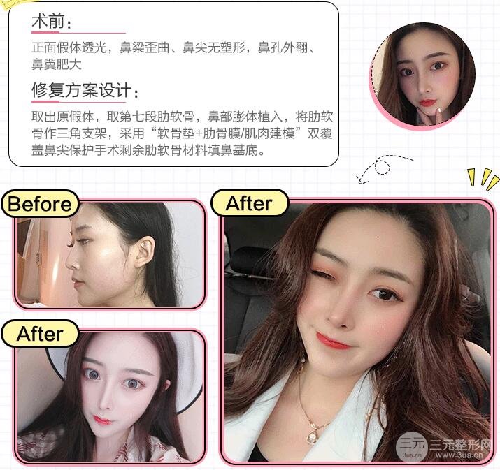 隆鼻失败别恐慌，修复手术成功的几率还是很大的！