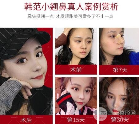 惊了！膨体隆鼻术容易感染的原因竟然是ta！
