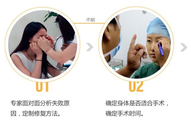 什么是埋线双眼皮?