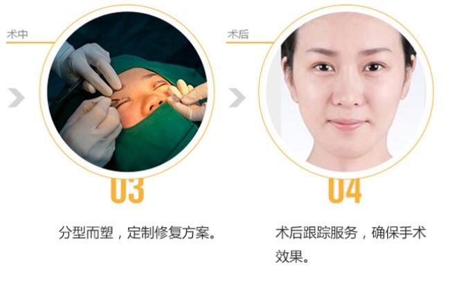 什么是埋线双眼皮?