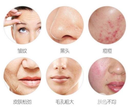 白瓷娃娃和光子嫩肤的区别