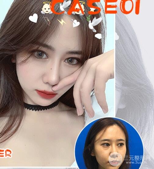 白瓷娃娃和光子嫩肤的区别