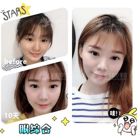 赣州华美整形医院王春院长案例图