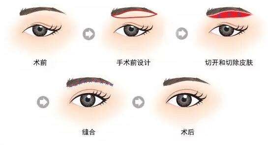 #术前须知#眉部整形手术有哪些？术后注意事项有哪些？