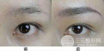 #术前须知#眉部整形手术有哪些？术后注意事项有哪些？