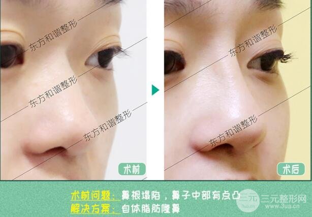 自体脂肪隆鼻优缺点