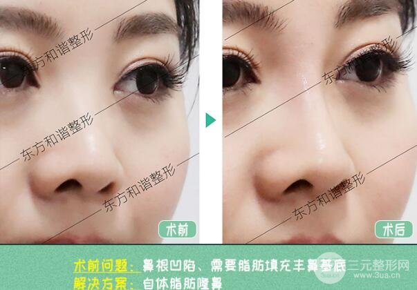 自体脂肪隆鼻果图