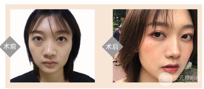 去眼袋多少钱?