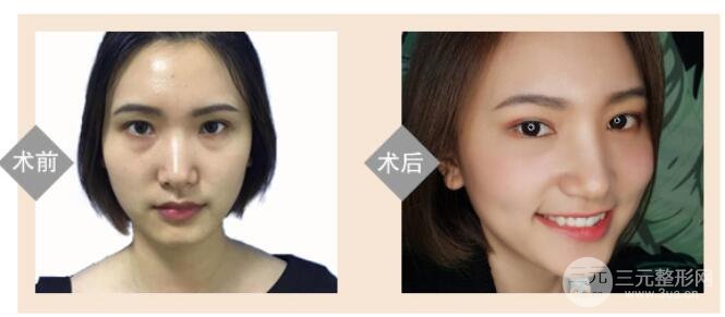 去眼袋多少钱?