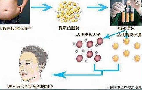 自体脂肪填充手术原理