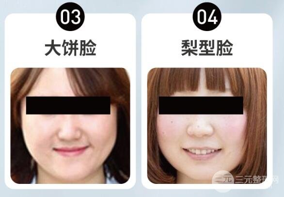 面颊吸脂多久完全消肿?