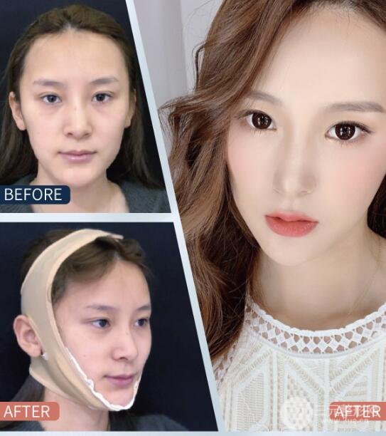颊吸脂手术前的注意事项