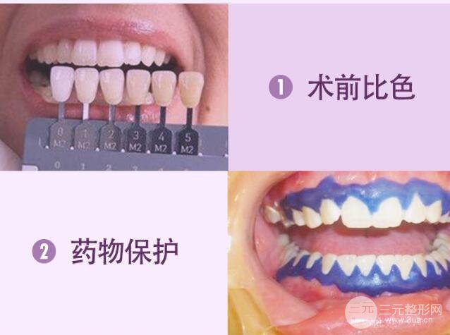 什么是牙齿冷光美白?
