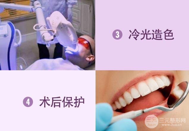什么是牙齿冷光美白?