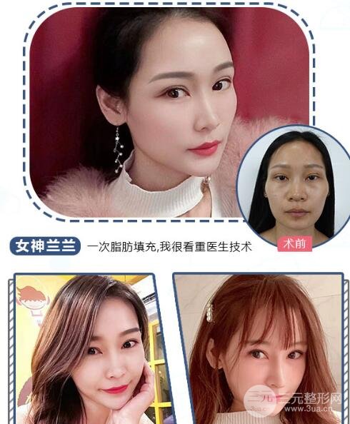 自体脂肪填充太阳穴成好吗?