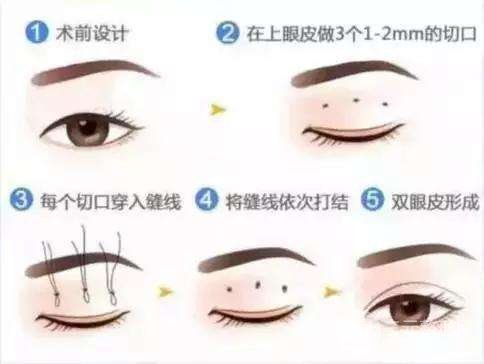 北京微创双眼皮手术多少钱?不同方法适合不同人群~