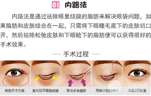 内路去眼袋多久能恢复？适合哪些人群做？