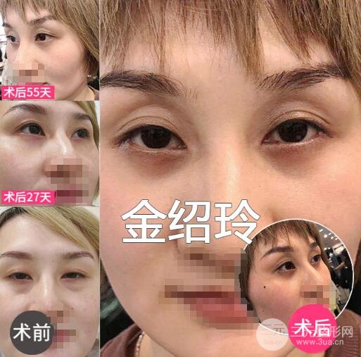 内路去眼袋多久能恢复？适合哪些人群做？