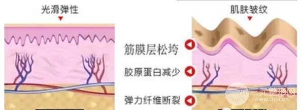 热玛吉除皱果能维持多久?看图就知道了!