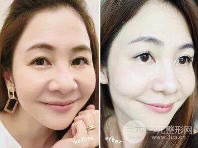 热玛吉除皱果能维持多久?看图就知道了!