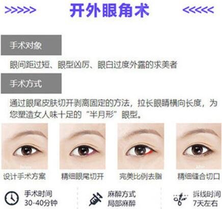 北京开外眼角价格