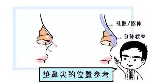鼻头缩小术多少钱？这价格让你“真香”！