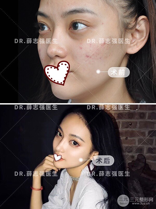 鼻头缩小术多少钱？这价格让你“真香”！